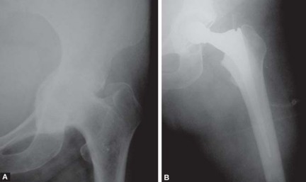 Illustration 20 for Total Hip Replacement for Protrusio: Restore Your Hip Function