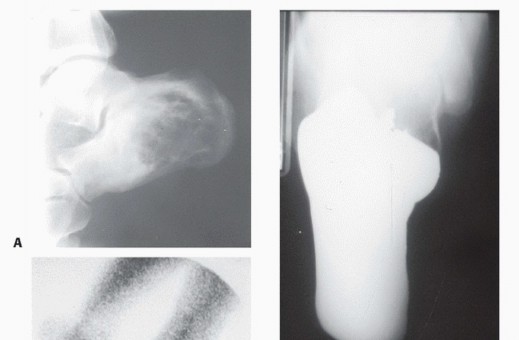 Illustration 13 for Treating Tumors of the Foot: Optimizing Amputation & Resection
