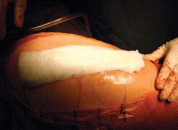 Illustration 76 for Metal on Metal Resurfacing: Enhanced Posterior Soft Tissue Repair