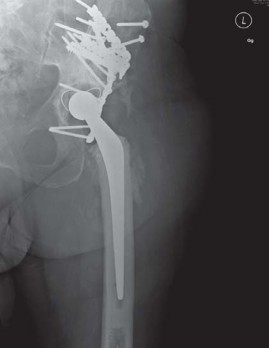Illustration 32 for Management of Periprosthetic Fractures: An Expert Surgical Guide
