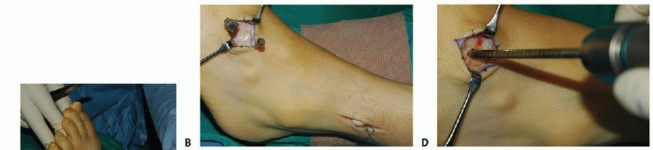 Illustration 13 for Restore Movement: Tendon Transfer for Common Peroneal Nerve Foot Drop