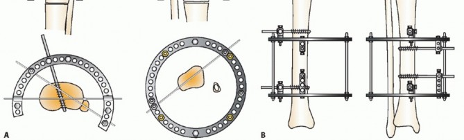 Illustration 15 for Beyond Amputation: Circular Fixation for Infection of the Talus