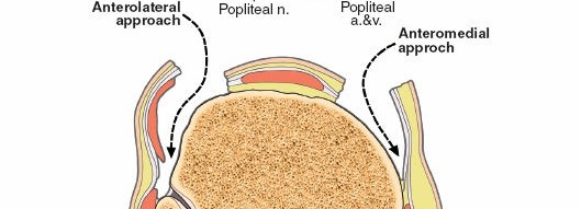 Illustration 5 for Surgical Access: Mastering the Tibia's Surface & Fibula Approaches