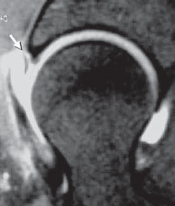 Illustration 25 for Solving Hip Soft Tissue Pathology with Advanced Arthroscopy