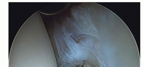 Illustration 22 for Hip Arthroscopy: Your Minimally Invasive Solution for Hip Pain