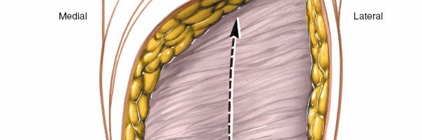 Illustration 177 for Mastering Knee Approaches: Spotlight on Superficial Medial Ligament