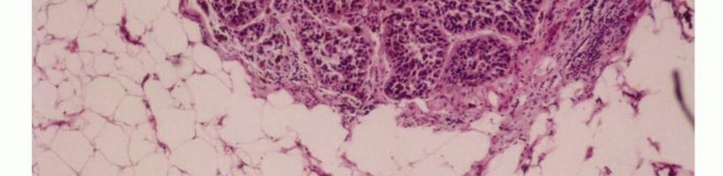 Illustration 29 for Precision Biopsy of Musculoskeletal Tumors for Accurate Diagnosis