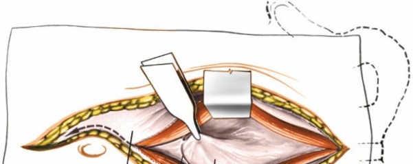 Illustration 13 for Expert Guide: Transperitoneal and Retroperitoneal Lumbar Access
