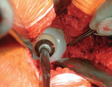 Illustration 26 for Optimizing Acetabular Component Cementation for Superior Outcomes