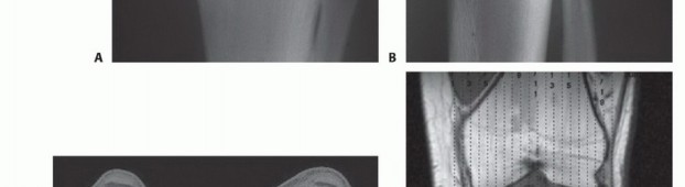 Illustration 7 for Tackling Complex Tumors of the Proximal Tibia: Limb-Sparing Solutions