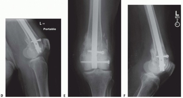 Illustration 24 for Repairing Distal Femur Fractures: Open Reduction & Internal Fixation