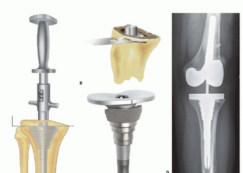 Illustration 2 for Tibial Bone Loss in TKA Revision: Augments for Complex Cases