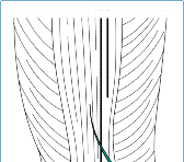 Unlock Knee Alignment: Your Guide to Distal Femoral Osteotomy