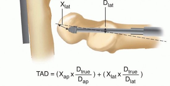 Illustration 22 for ORIF for Peritrochanteric Hip Fractures: Achieve Stable Mobility