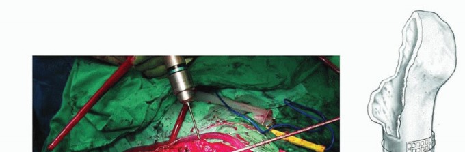 Illustration 21 for Exeter Hip Unit: Mastering Impaction Allografting for Femoral Bone Loss