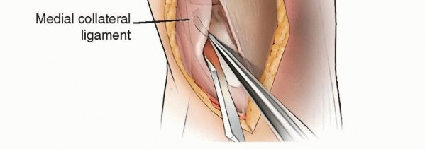 Illustration 10 for High Tibial Osteotomy: Realignment for Lasting Knee Pain Relief