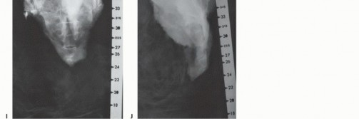 Illustration 55 for Sacral Tumor Surgery: Safeguarding Bowel & Bladder Control