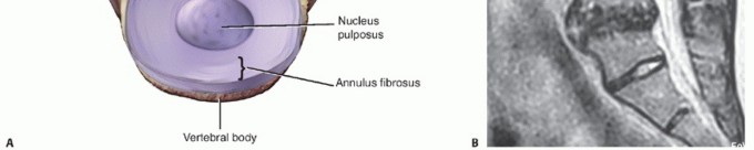 Illustration 2 for Anterior Lumbar Interbody: Fusion, Disc Replacement & Pain Relief