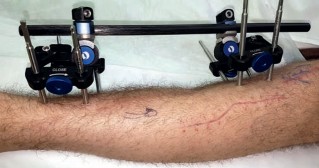 Illustration 11 for Tibial Fracture Extending into the Plafond: Intramedullary Secrets