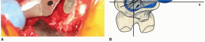 Illustration 22 for Recreate Hip Biomechanics: Modular Stems for Modular Solutions