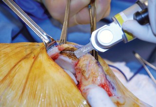 صورة طبية: تقويم مفصل الركبة أحادي الحجرة دليل شامل للمرضى في صنعاء