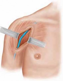 Illustration 12 for Mastering Pediatric Shoulder Fractures: Clinical Insights