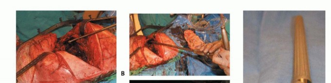 Illustration 13 for Hip Reimplantation Surgery: The Solution for Infected Implants