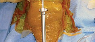 Illustration 19 for Optimize Tibial Component Alignment: Techniques for TKA Success