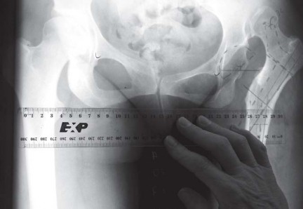 Illustration 8 for Successful Total Hip Replacement in Developmental Dysplasia