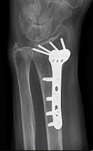 صورة طبية: دليل الأستاذ الدكتور محمد هطيف الشامل لأمراض وإصابات اليد والمعصم في صنعاء