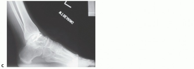 Illustration 5 for Unlock Stability: Medullary Nail Fixation for Tibiotalocalcaneal Arthrodesis