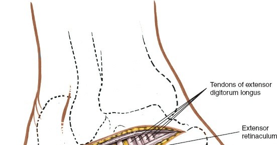 Illustration 105 for Optimized Approaches to the Dorsum of the Foot & Ankle
