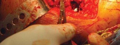 Illustration 59 for The Silent Hip: Achieving a Truly Silent, Pain-Free Joint