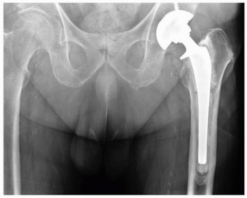 Illustration 6 for Mastering Revision THA: Strategies for Adverse Local Tissue Challenges