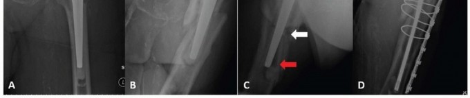 Illustration 4 for Mastering Fixation of Periprosthetic Fractures of the Femur