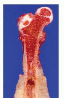 Illustration 14 for Beyond Amputation: Total Femur Resection with Endoprosthetics