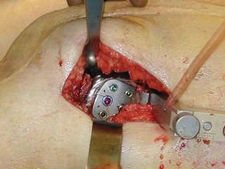 Illustration 16 for Mastering Periprosthetic Femoral Fractures Above Knee Arthroplasty