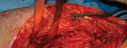 Illustration 79 for Femoral Stem Revision: Posterior Approach for Better Outcomes