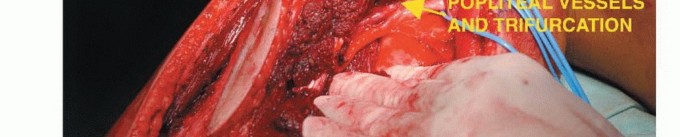 Illustration 37 for Beyond Amputation: The Type I Resection in Fibular Tumor Surgery