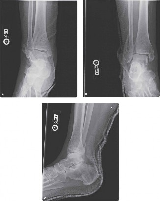 Illustration of case syndesmotic injury - Dr. Mohammed Hutaif