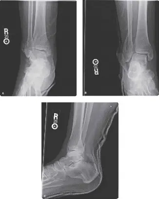 صورة توضيحية لـ إصابة مفصل الكاحل الرباطي (الرباط الظنبوبي الشظوي): دليلك الشامل للتشخيص والعلاج مع الأستاذ الدكتور محمد هطيف