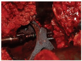 Illustration 9 for Uncemented Acetabular Component: Augments & Cup-Cages for Bone Loss
