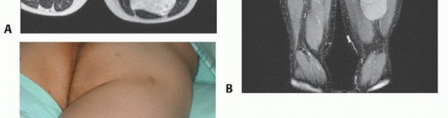 Illustration 5 for Posterior Thigh Resection: Rethinking Outcomes & Limb Sparing