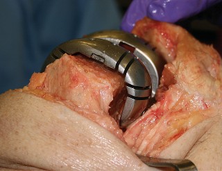 Illustration 18 for Understand Augments: The Role of Metal Augments in Arthroplasty