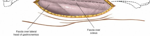 Illustration 76 for Surgical Access: Mastering the Tibia's Surface & Fibula Approaches
