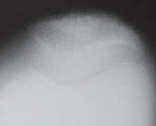 Illustration 95 for Optimizing Single-Bundle Anterior Cruciate Ligament Repair