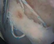 Illustration 24 for Resolving Femoral Head Neck Impingement: Arthroscopic FAI Solutions