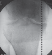 Illustration 26 for Guide Pin Assembly: Key to Flawless Upper Tibial Osteotomy