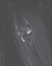 Illustration 6 for Precision Arthroscopy for Chondral Injuries & OCD: Direct Lateral Portal