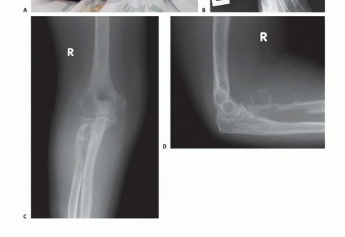 Illustration 4 for Above-Elbow & Below-Elbow Amputations: When & Why They're Needed
